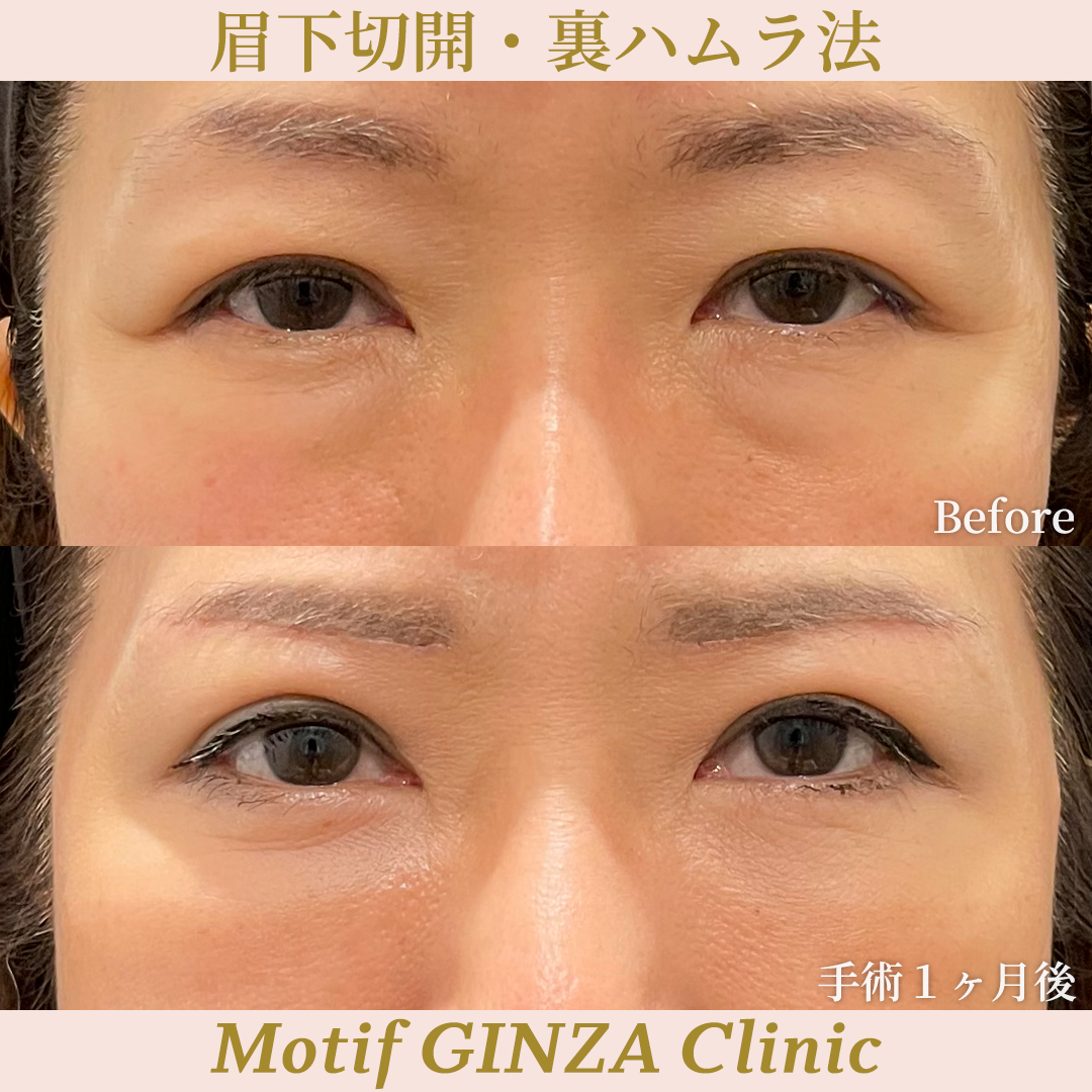 眉下切開・裏ハムラ法（手術３ヶ月）の写真3