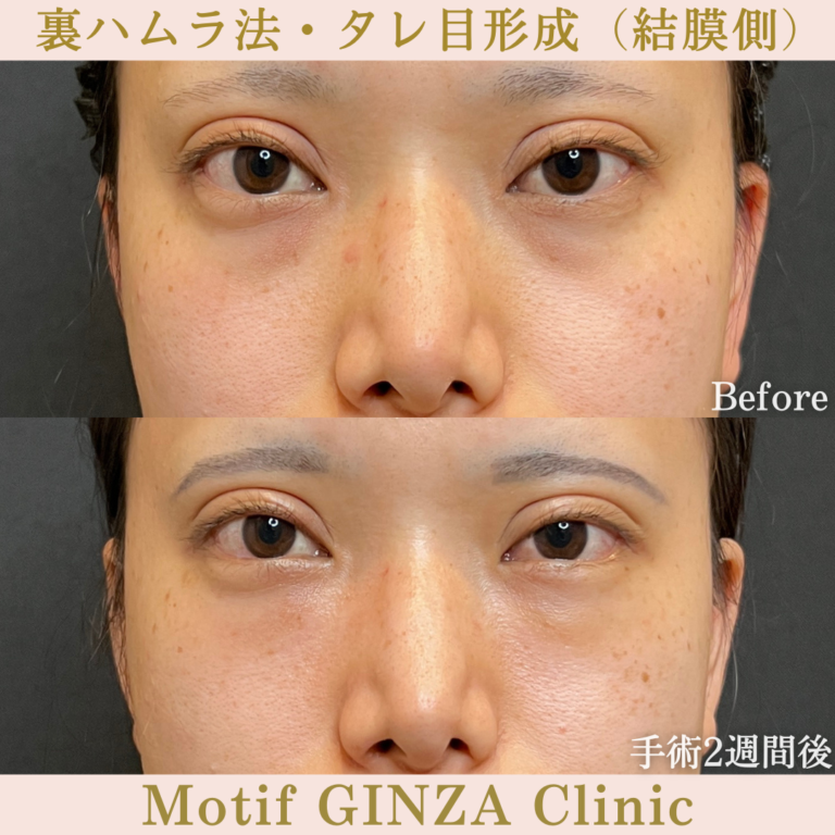 裏ハムラ法・タレ目形成（結膜側）（手術３か月）の写真5