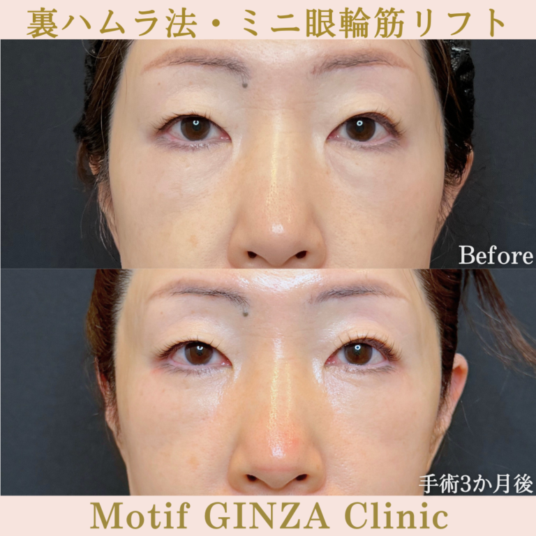 裏ハムラ法・ミニ眼輪筋リフト（手術３か月）