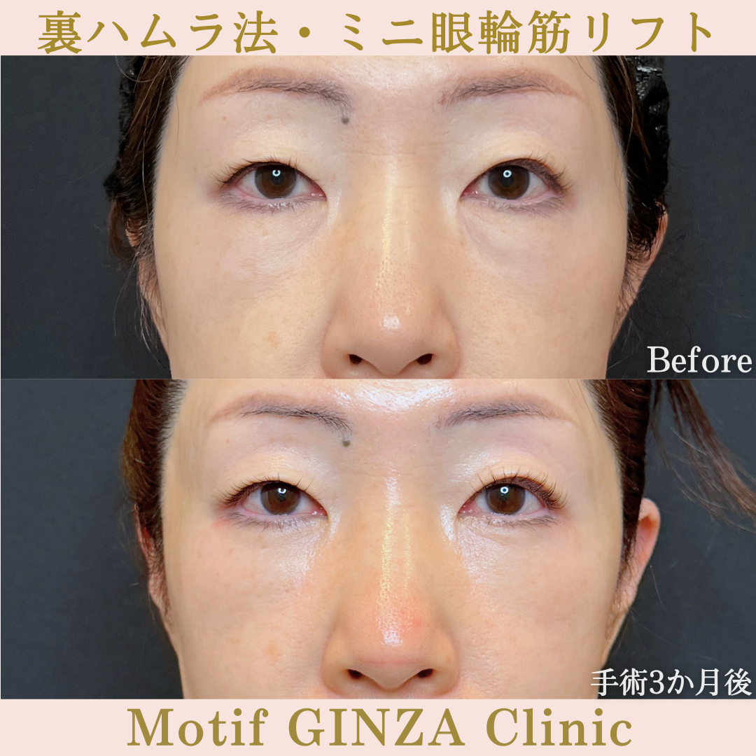 裏ハムラ法・ミニ眼輪筋リフト（手術6か月）の写真2