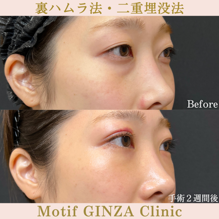 裏ハムラ法・二重埋没法(手術3か月)の写真6