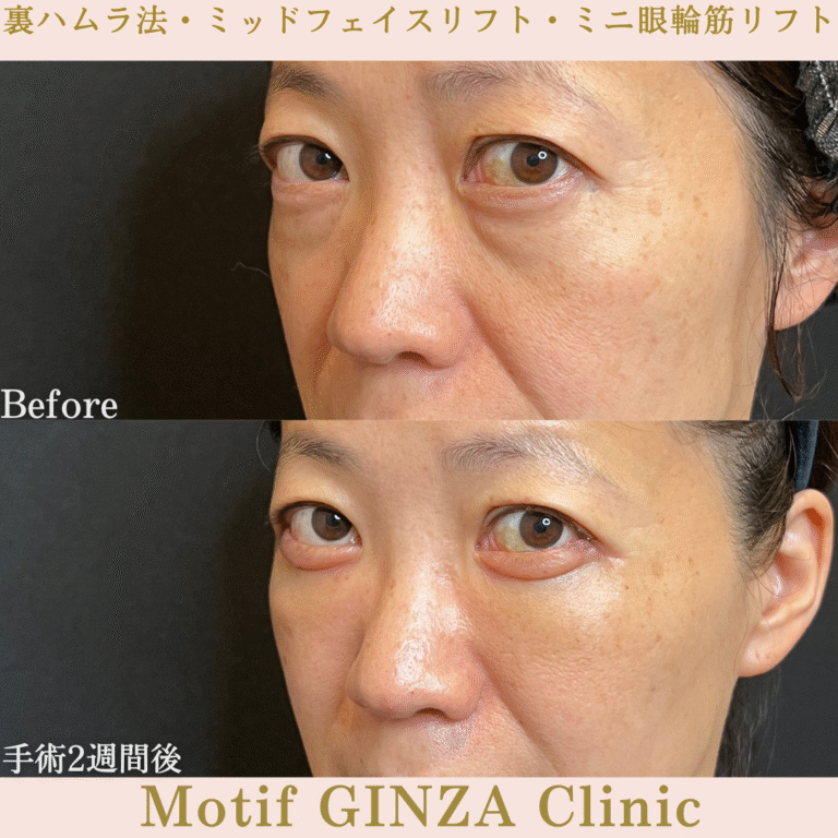裏ハムラ法・ミッドフェイスリフト・ミニ眼輪筋リフト（手術１か月）の写真5