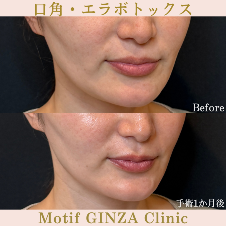 口角・エラボトックス（手術１か月）の写真2