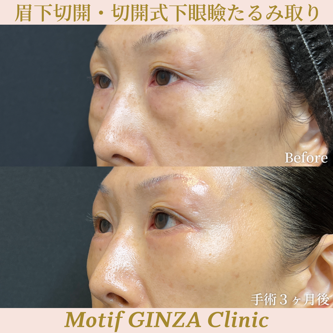 眉下切開・切開式下眼瞼たるみ取り(手術3ヶ月)の写真2