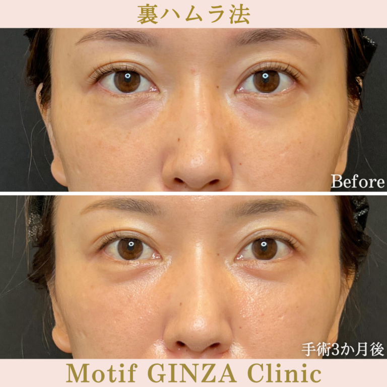 裏ハムラ法（手術3か月）