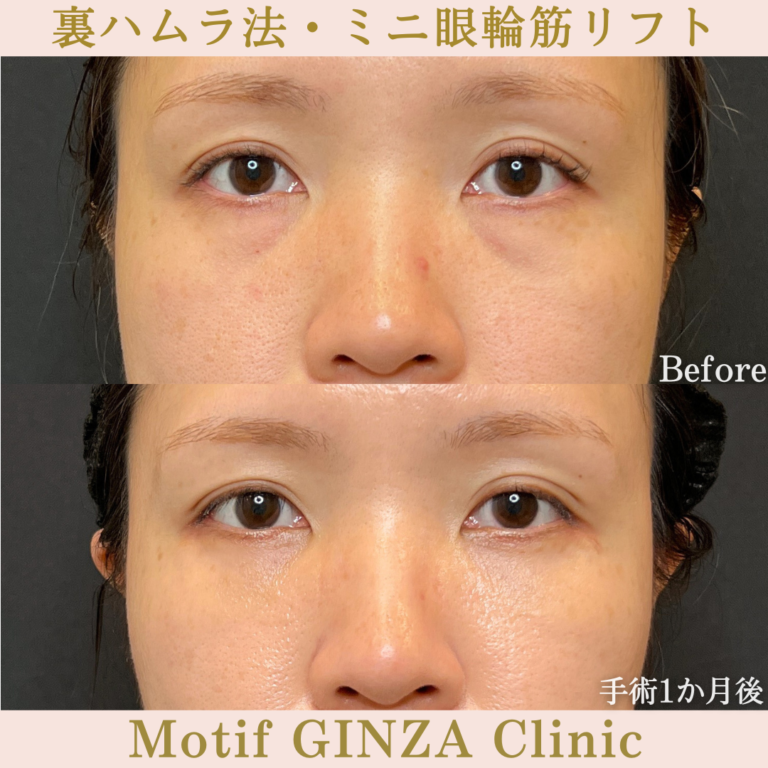裏ハムラ法・ミニ眼輪筋リフト（手術１か月）