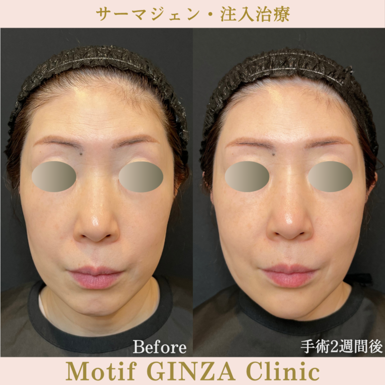 サーマジェン・注入治療(手術1か月)の写真3