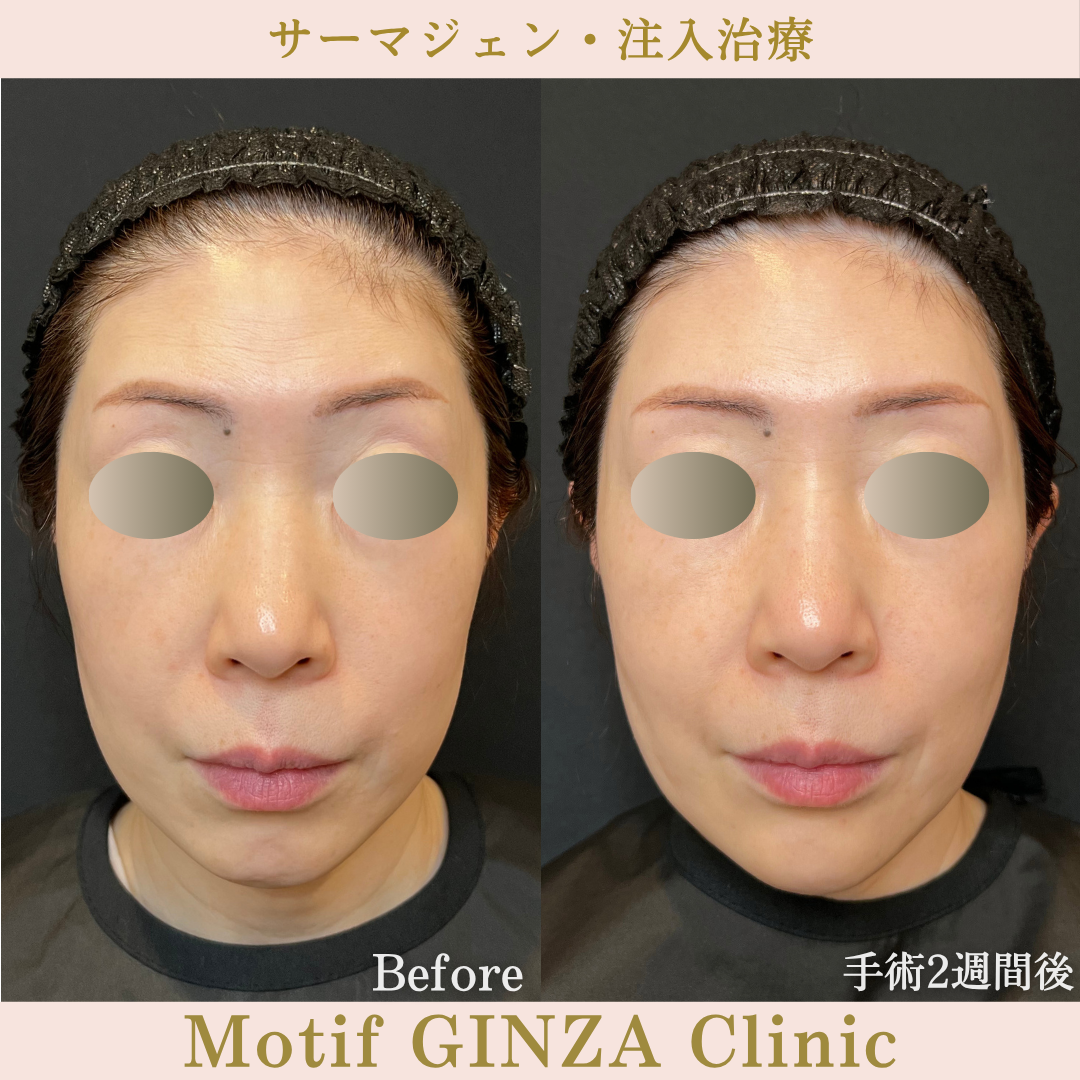 サーマジェン・注入治療(手術1か月)の写真3