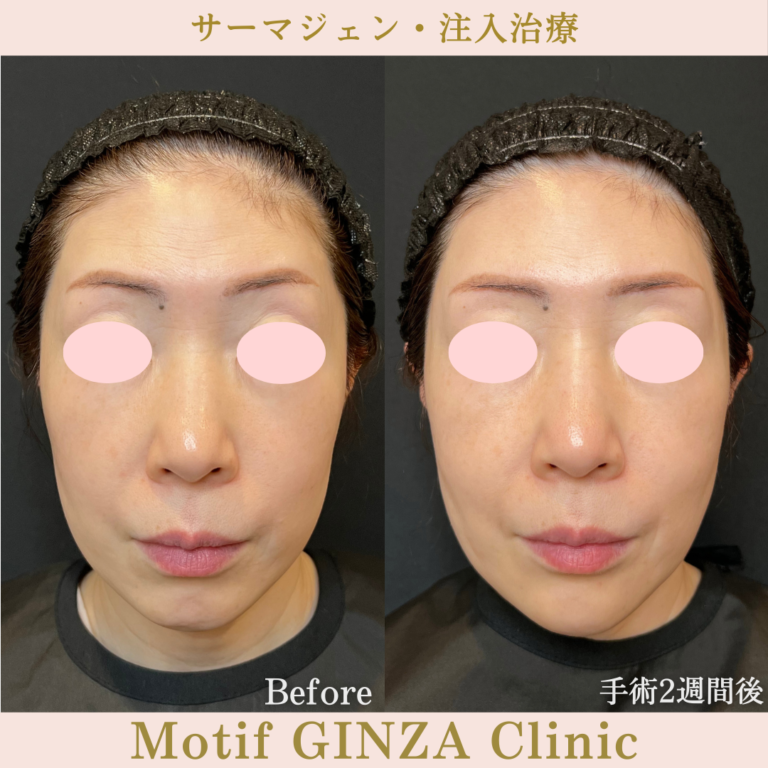 サーマジェン・注入治療（手術1か月）の写真3