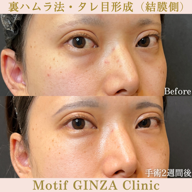 裏ハムラ法・タレ目形成（結膜側）（手術３か月）の写真6
