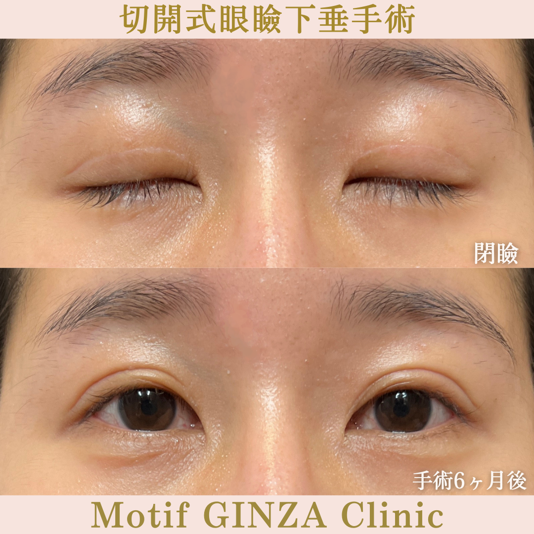 切開式眼瞼下垂手術（手術６ヶ月）の写真2