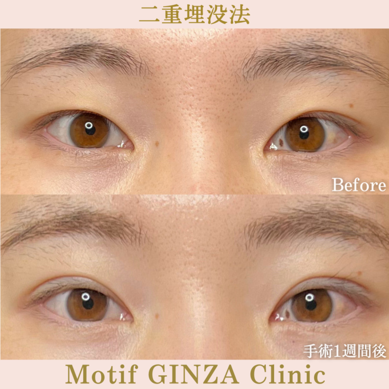 二重埋没法法（手術1か月）の写真2