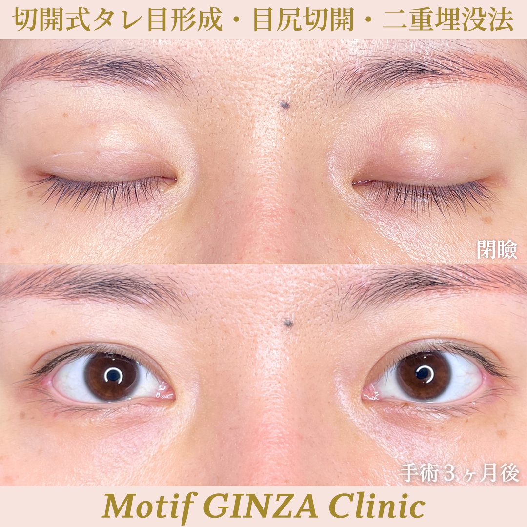 タレ目形成・目尻切開・二重埋没法(手術3ヶ月)の写真2