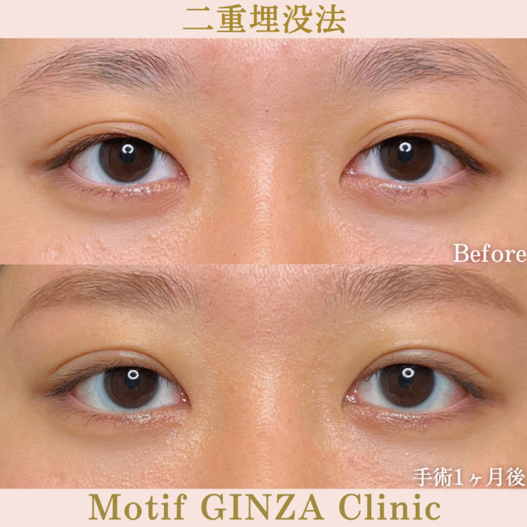 二重埋没法（手術１か月）