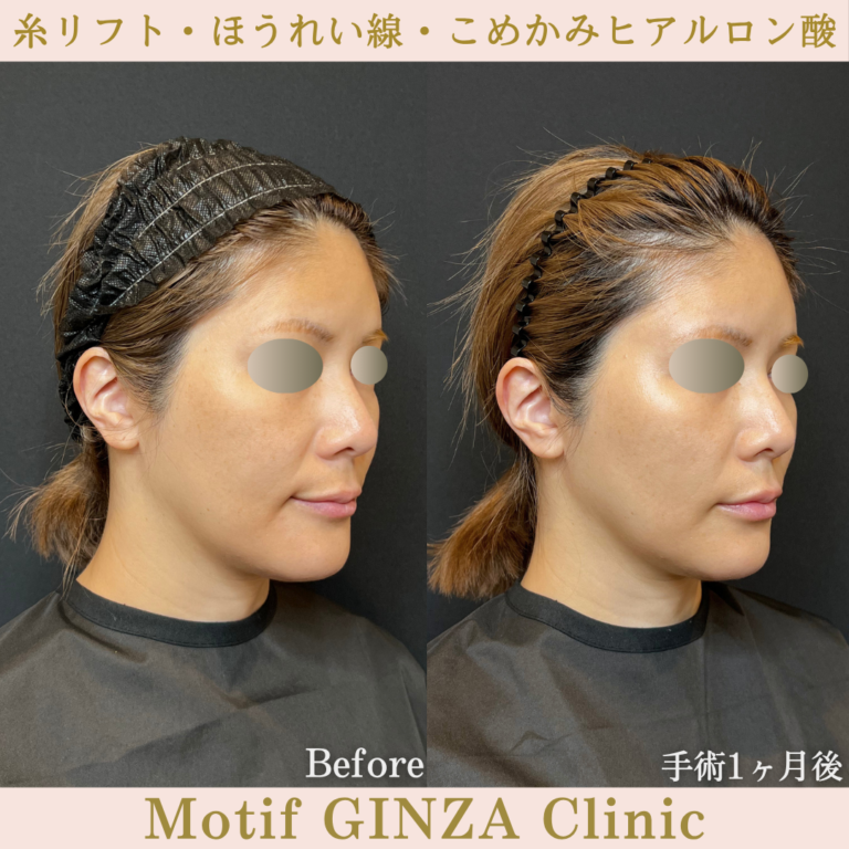 糸リフト・ほうれい線・こめかみヒアルロン酸(手術1か月)の写真2