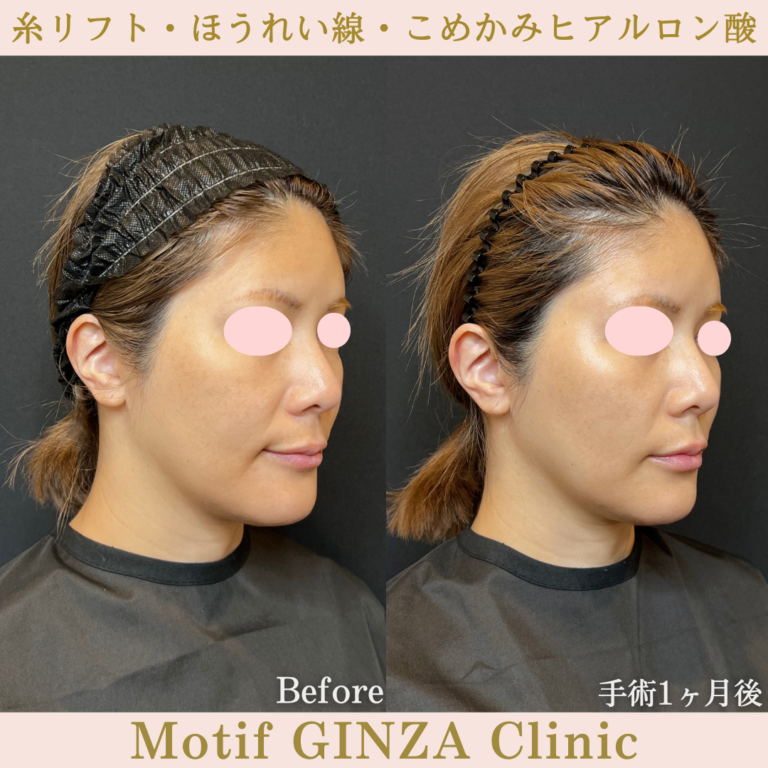 糸リフト・ほうれい線・こめかみヒアルロン酸（手術1か月）の写真2