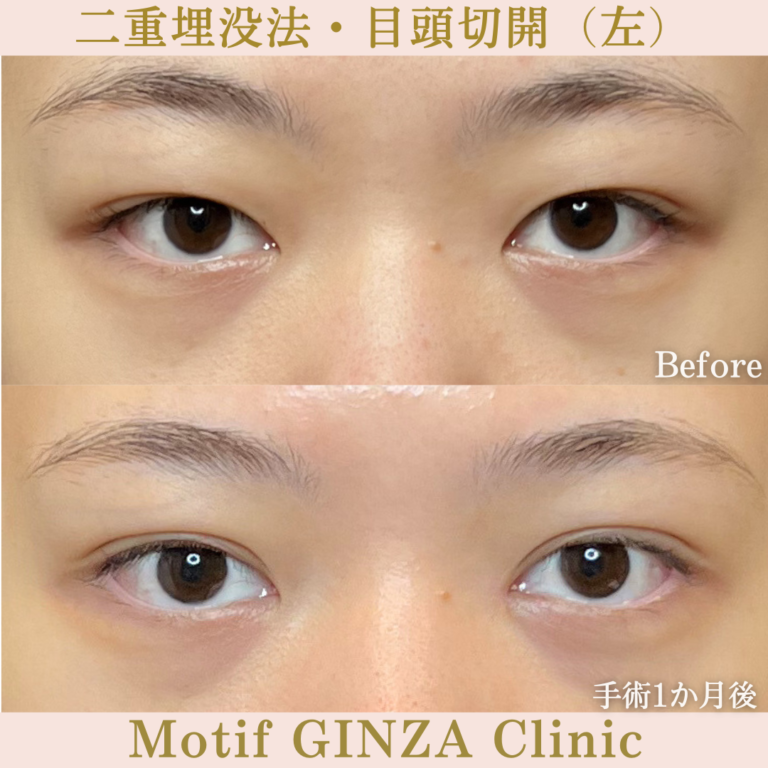 二重埋没法・目頭切開（手術３か月）の写真3