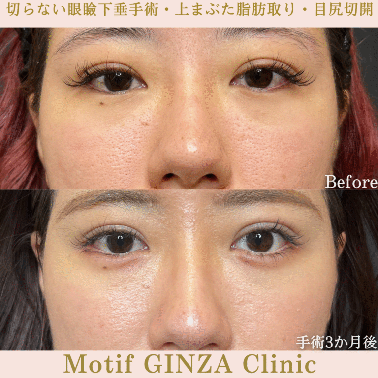 切らない眼瞼下垂手術・上まぶた脂肪取り・目尻切開(手術3か月)