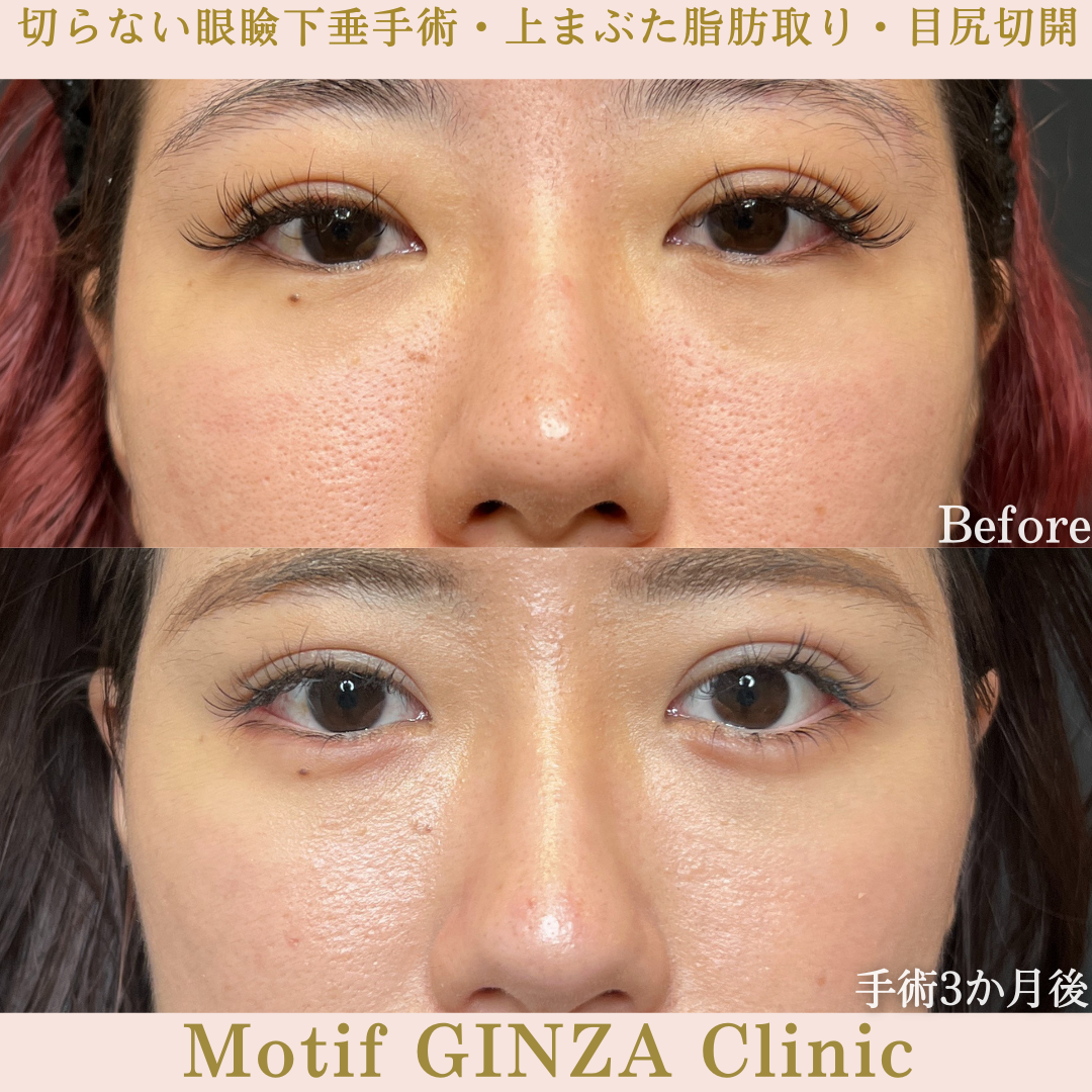 切らない眼瞼下垂手術・上まぶた脂肪取り・目尻切開（手術３か月）の写真