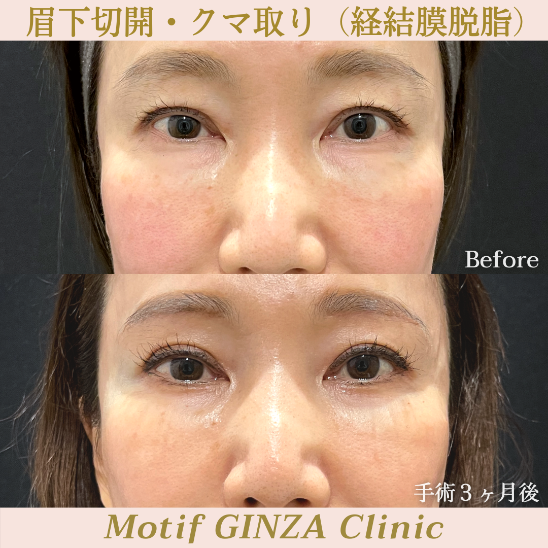 眉下切開・経結膜脱脂（手術７ヶ月）の写真3