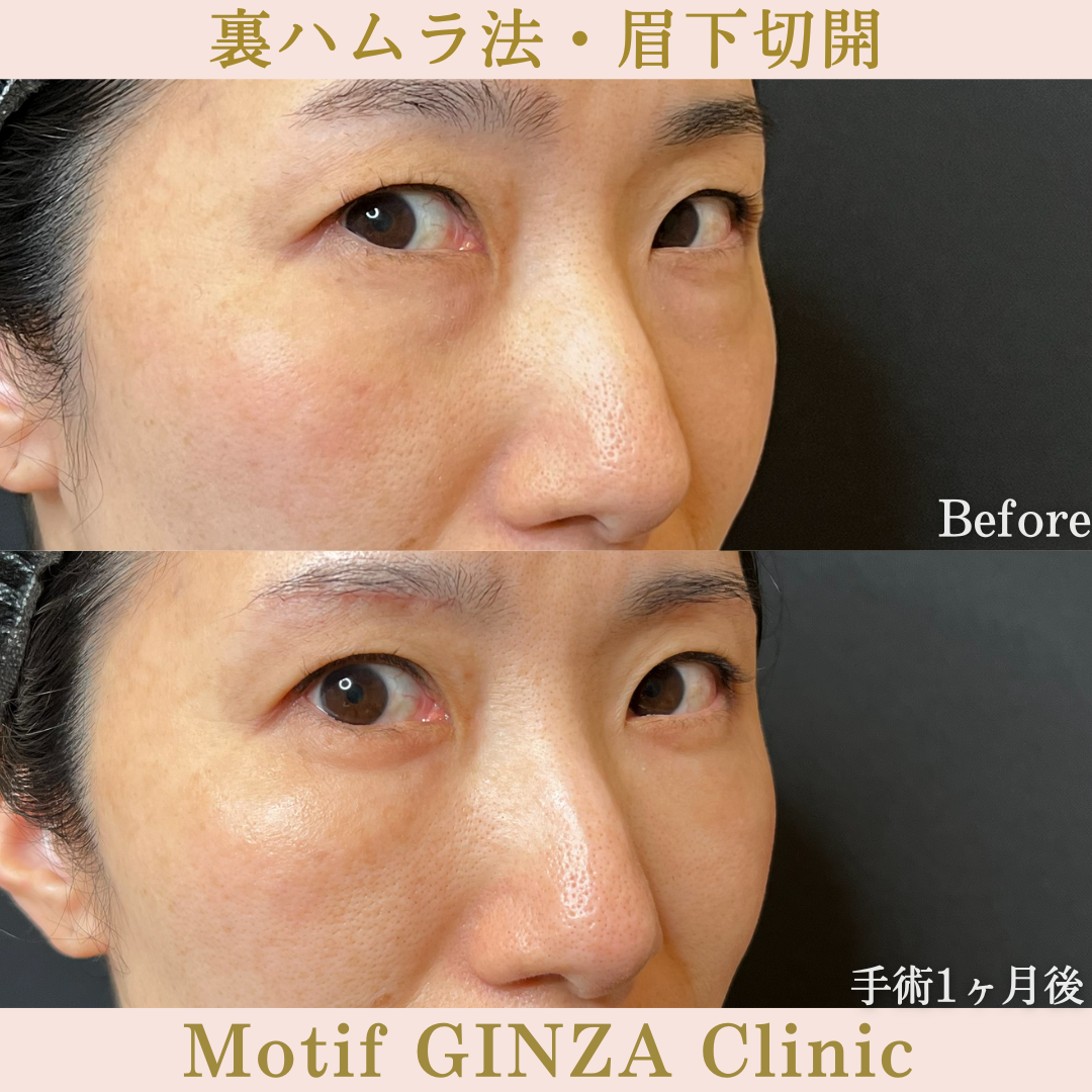 裏ハムラ法・眉下切開(手術6か月)の写真6