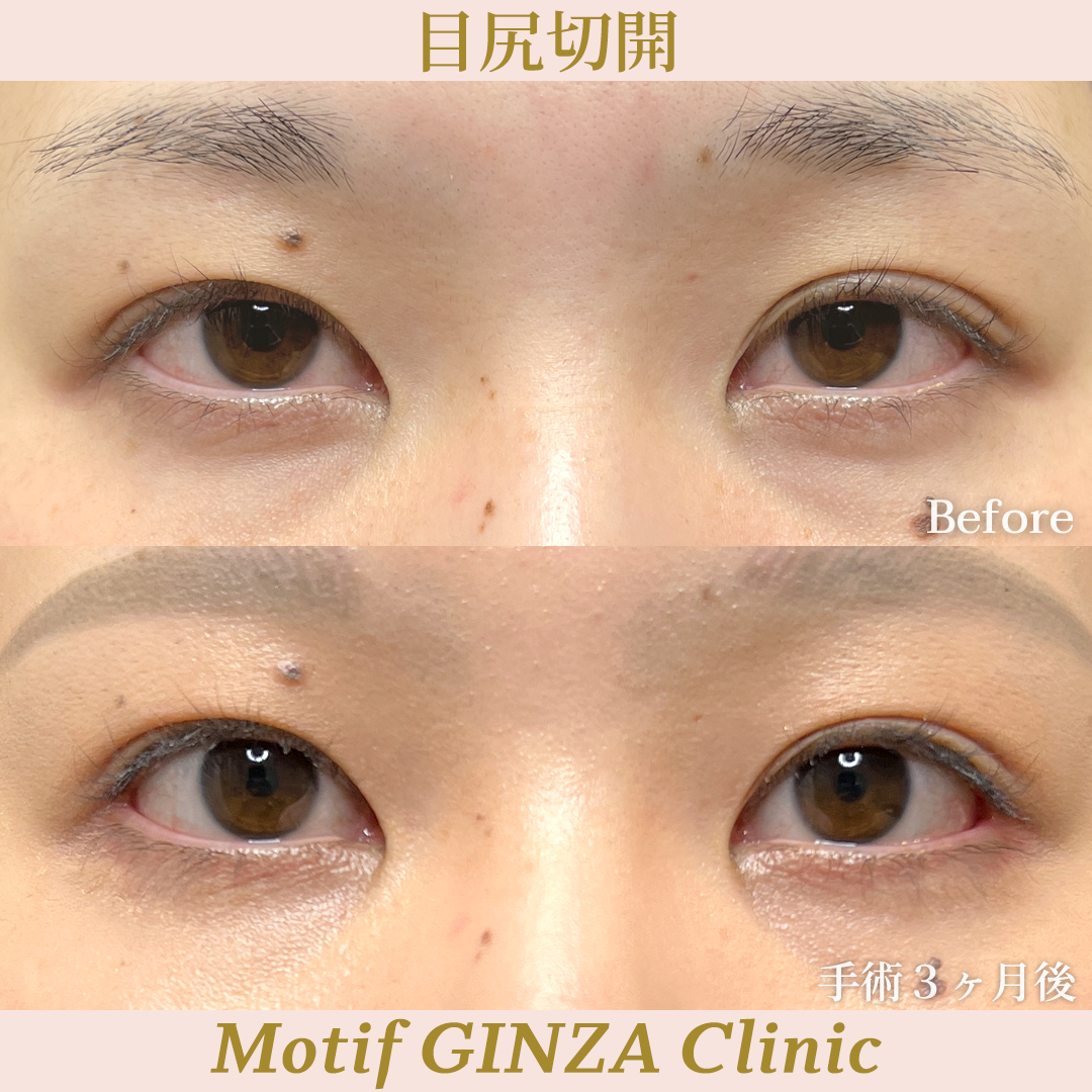 目尻切開手術（手術３ヶ月）の写真