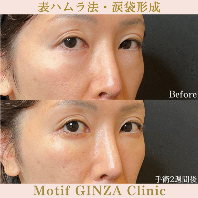 表ハムラ法・涙袋形成（手術３か月）の写真6