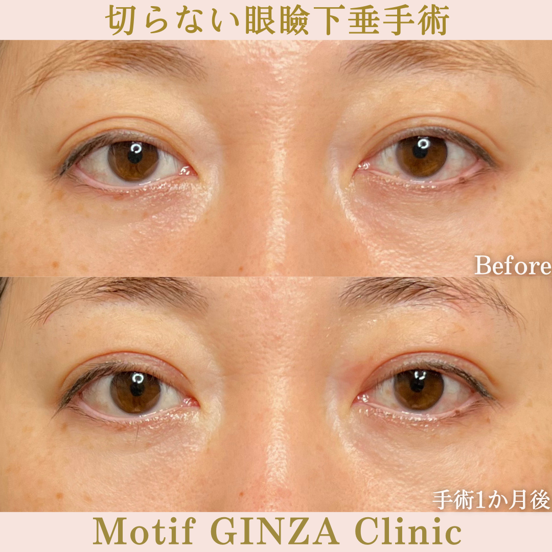 切らない眼瞼下垂手術（手術１か月）の写真