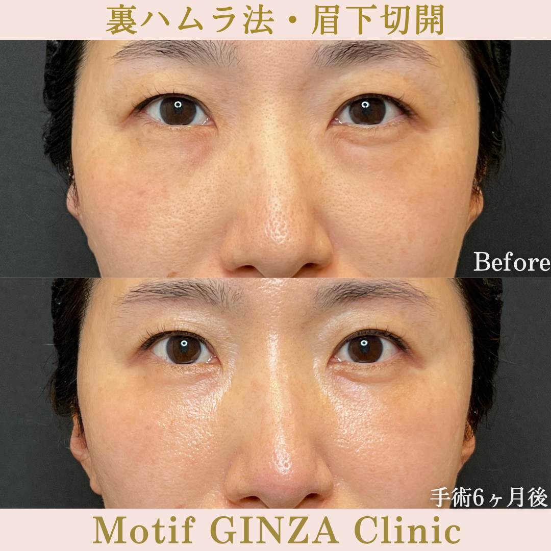 裏ハムラ法・眉下切開（手術6か月）の写真