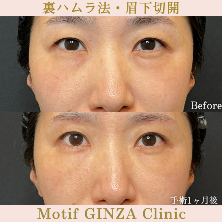 裏ハムラ法・眉下切開(手術3か月)の写真3