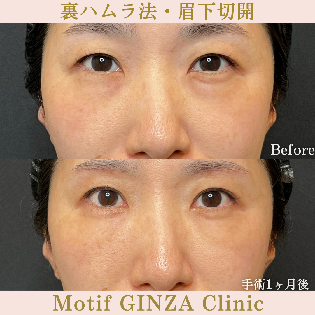 裏ハムラ法・眉下切開(手術6か月)の写真5
