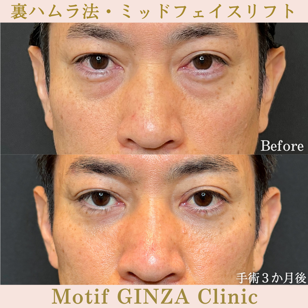裏ハムラ法・ミッドフェイスリフト(手術6か月)の写真3