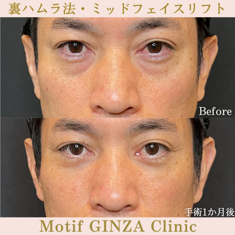 裏ハムラ法・ミッドフェイスリフト（手術1か月）