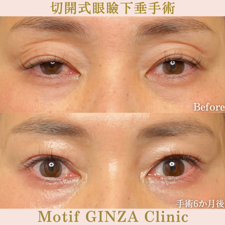 切開式眼瞼下垂手術(手術6か月)