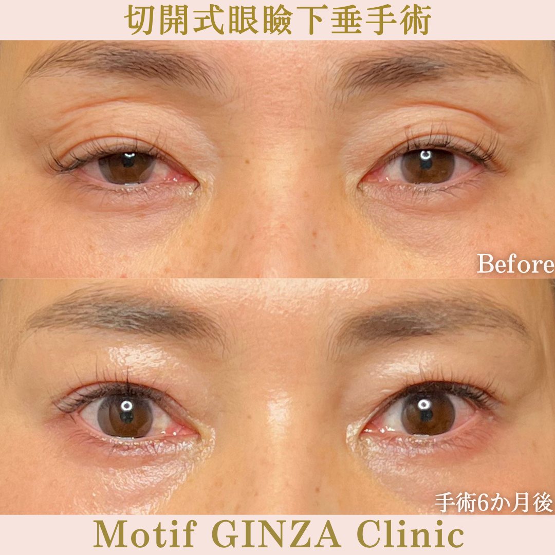 切開式眼瞼下垂手術（手術６か月）の写真