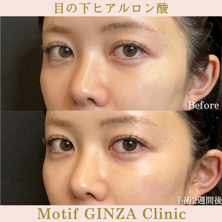 目の下ヒアルロン酸（手術2週間）の写真2