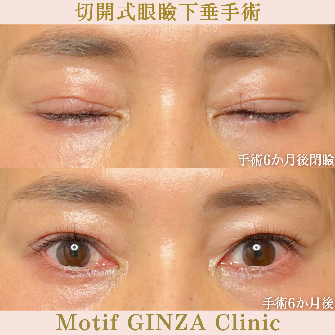 切開式眼瞼下垂手術（手術６か月）の写真2