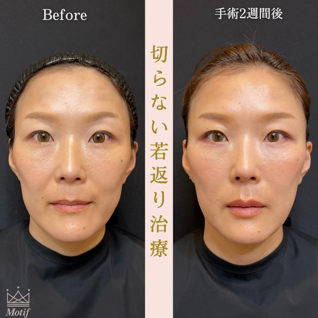 切らない若返り治療（手術２週間）の写真