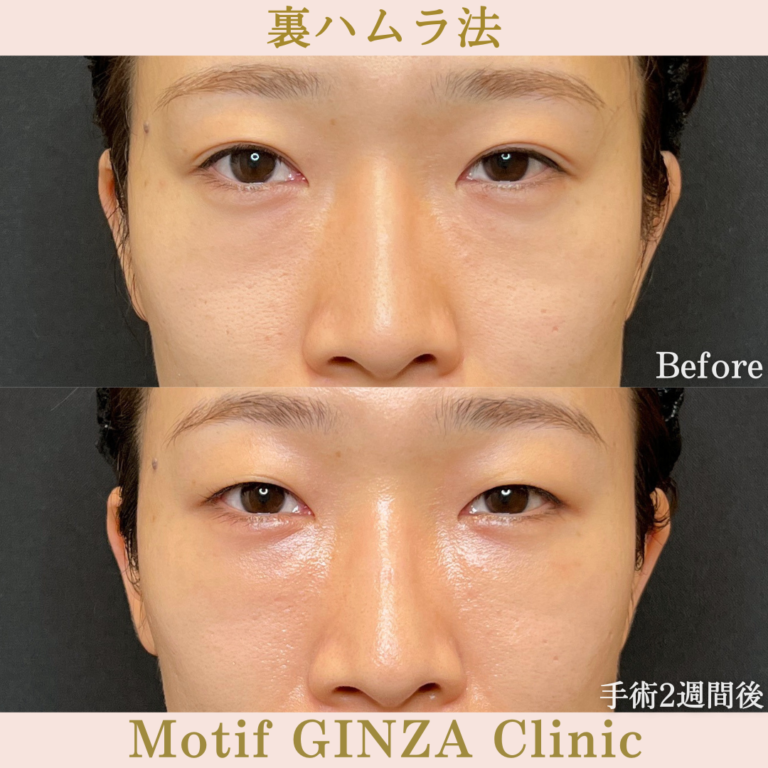 裏ハムラ法(手術1か月)の写真3