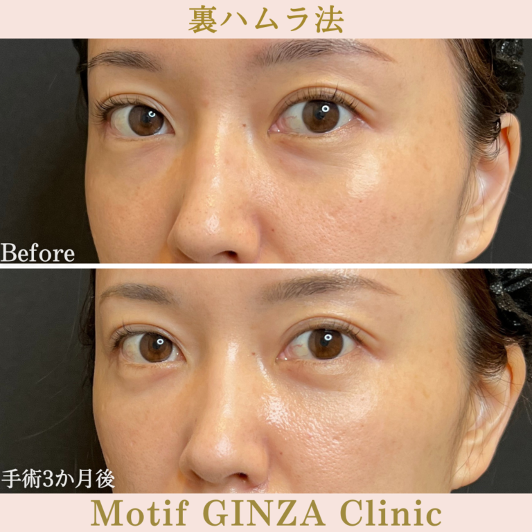 裏ハムラ法（手術3か月）の写真2