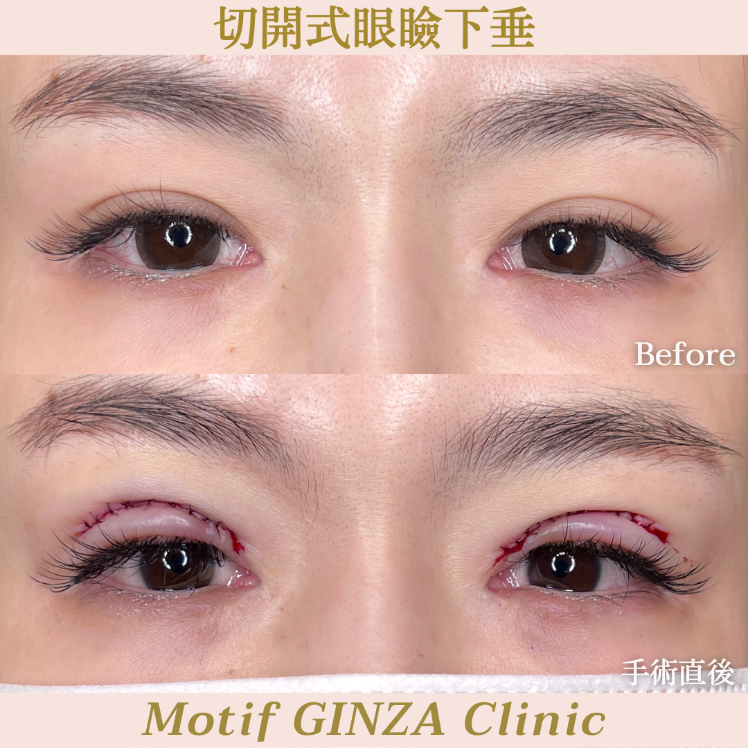 切開式眼瞼下垂手術(手術3ヶ月)の写真6