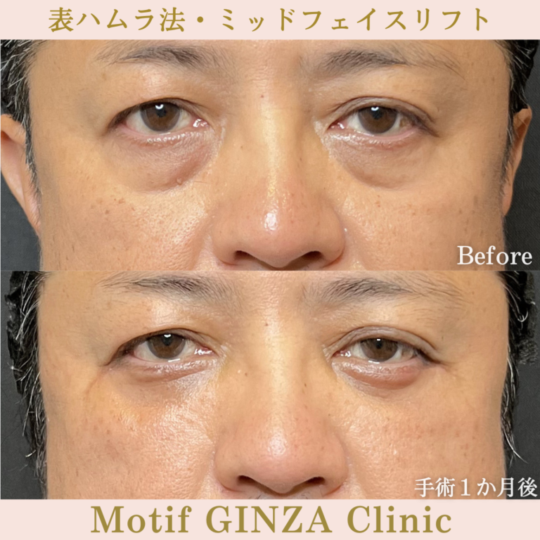 表ハムラ法・ミッドフェイスリフト（手術6か月）の写真5