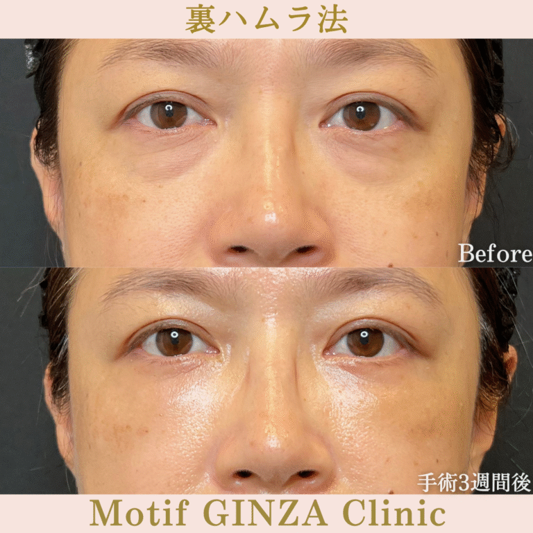 裏ハムラ法（手術３か月）の写真5