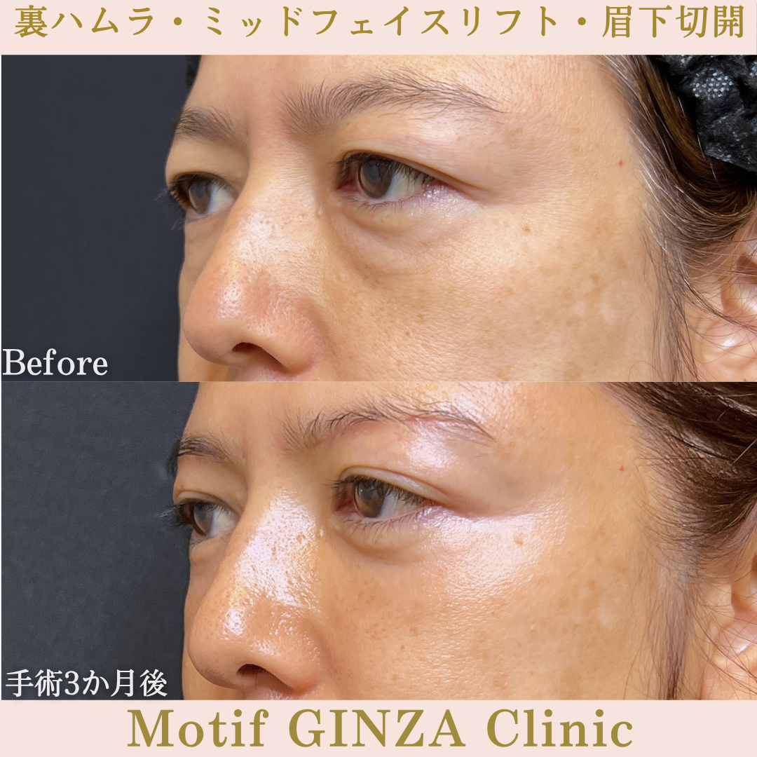 裏ハムラ法・ミッドフェイスリフト・眉下切開（手術６か月）の写真4