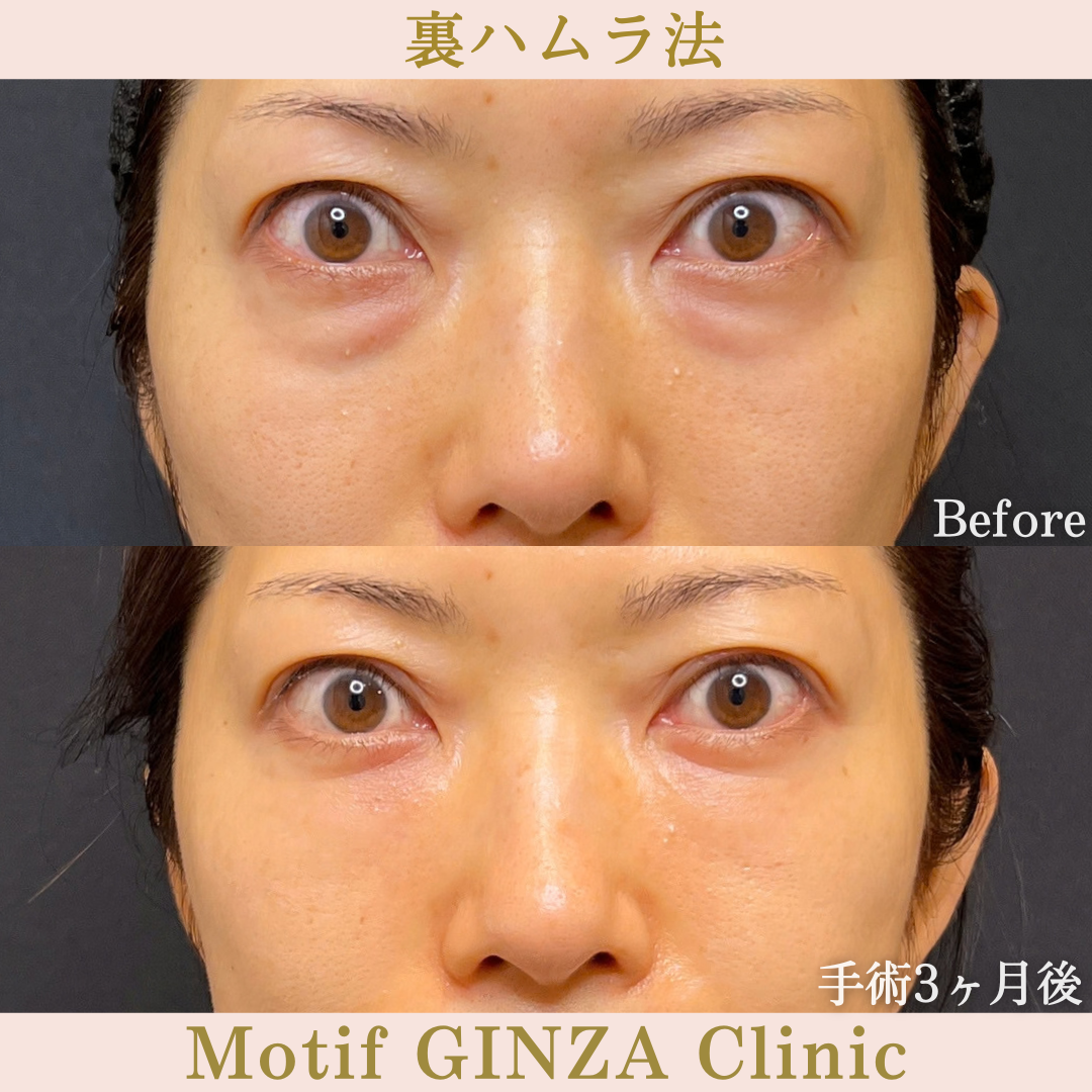 裏ハムラ法（手術7か月）の写真3