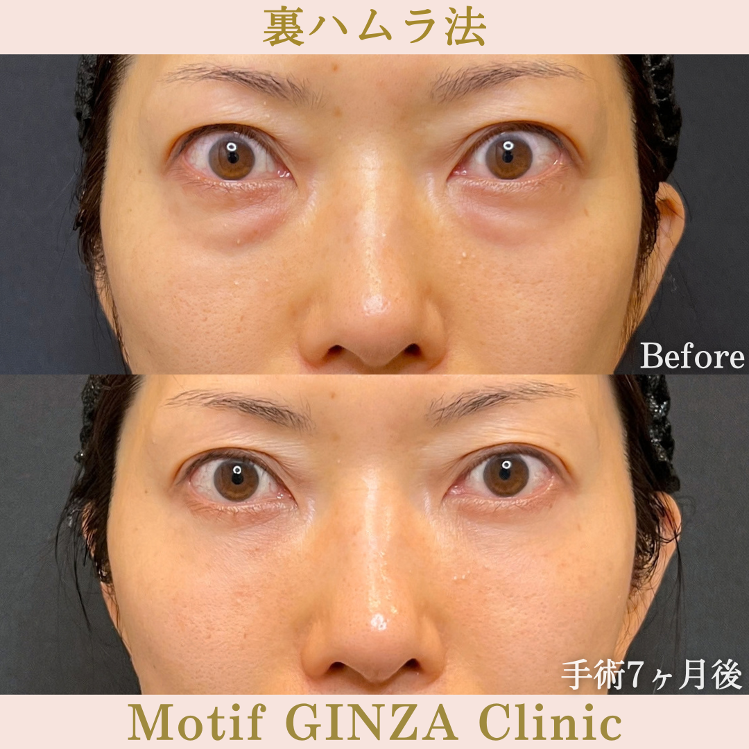 裏ハムラ法（手術7か月）の写真