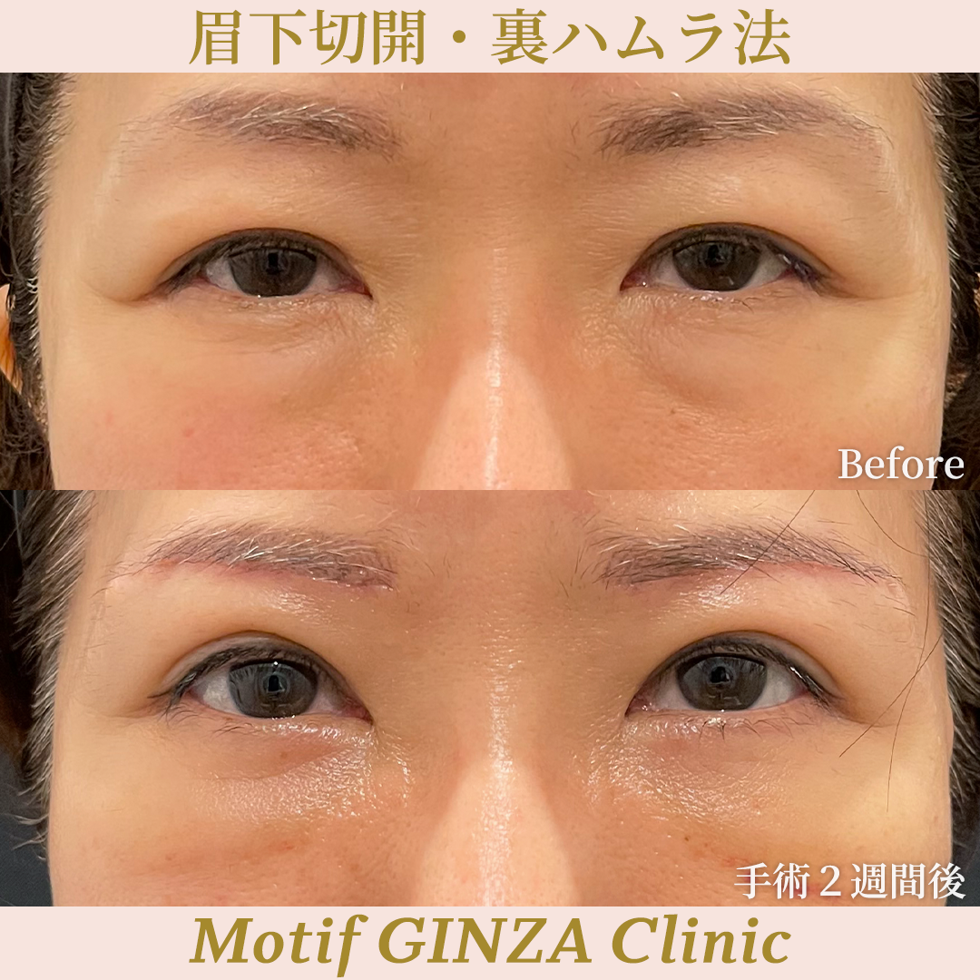 眉下切開・裏ハムラ法（手術３ヶ月）の写真4