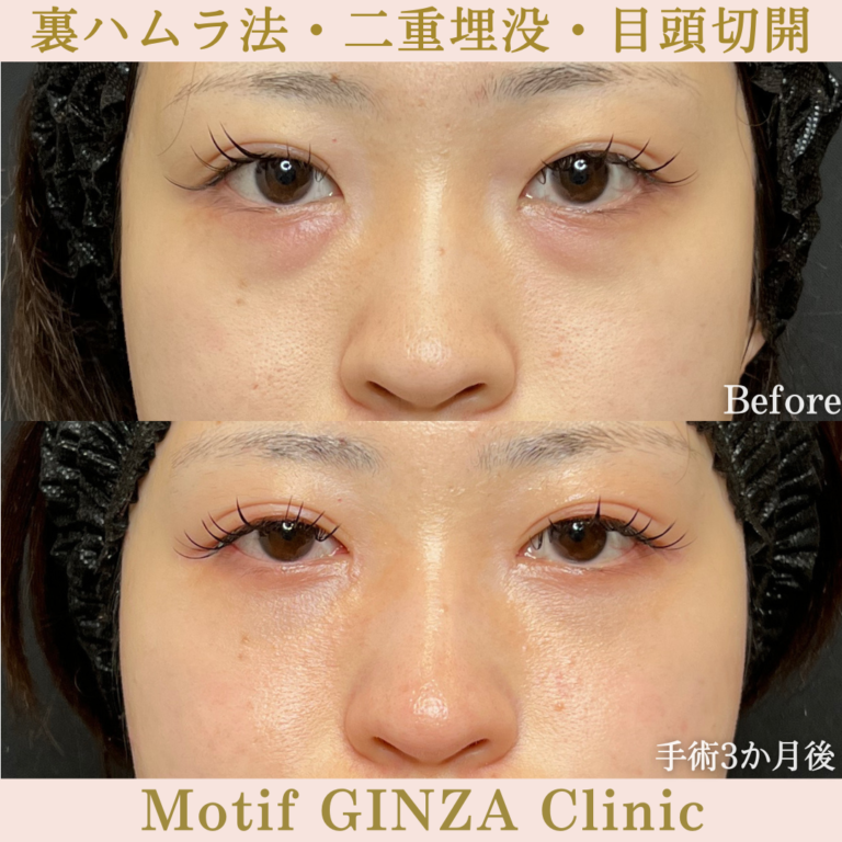 裏ハムラ法・二重埋没法・目頭切開(手術3か月)の写真2