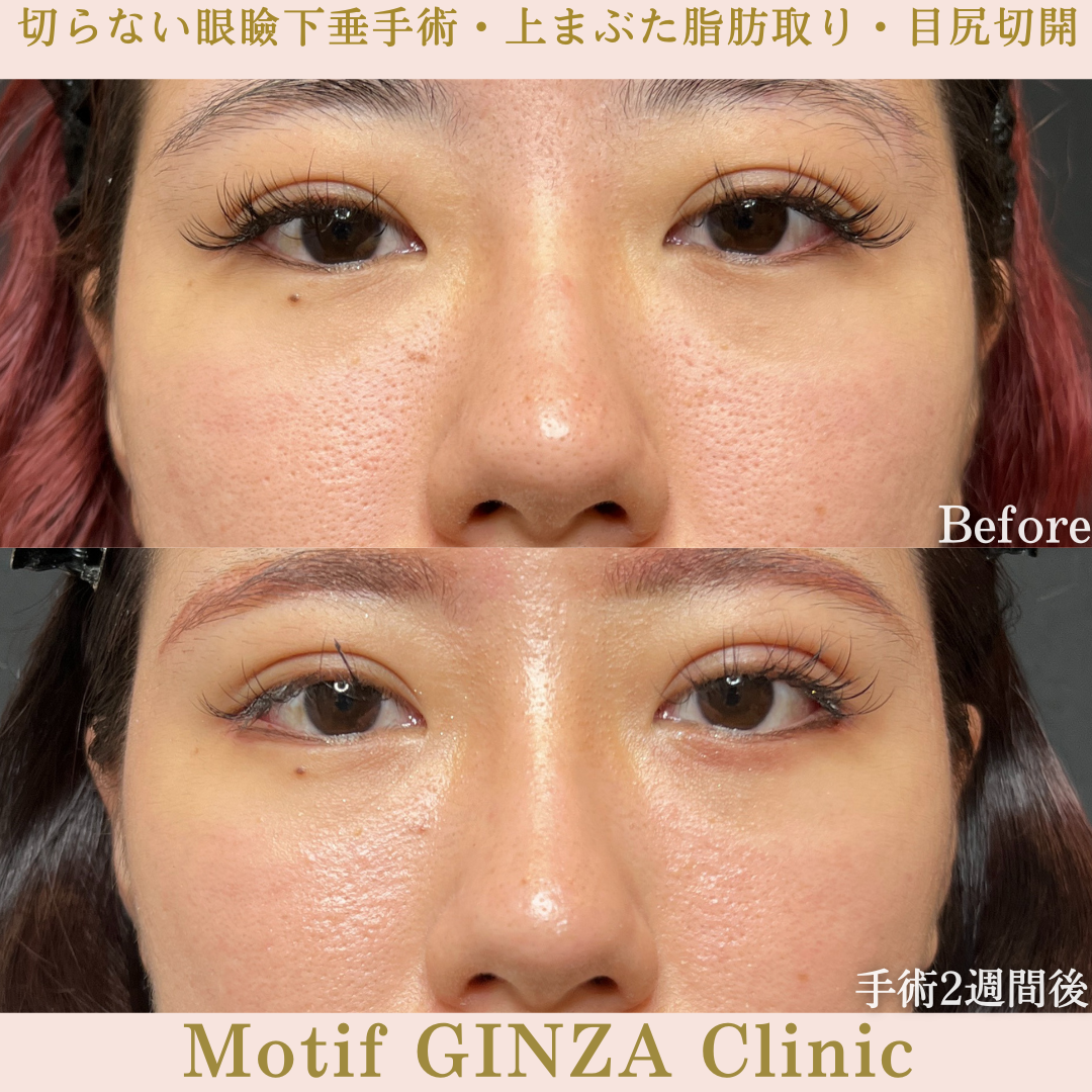 切らない眼瞼下垂手術・上まぶた脂肪取り・目尻切開（手術３か月）の写真3