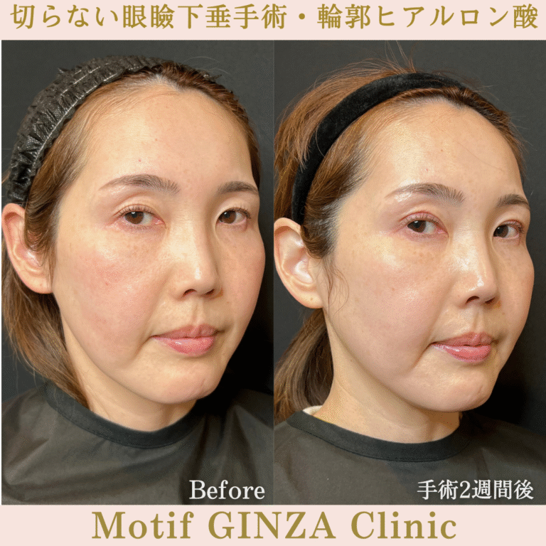 切らない眼瞼下垂手術・輪郭ヒアルロン酸（手術１か月）の写真4